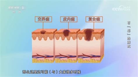 痣是凸的|身上的痣能抠吗？凸起的痣和平平的痣哪个更易恶。